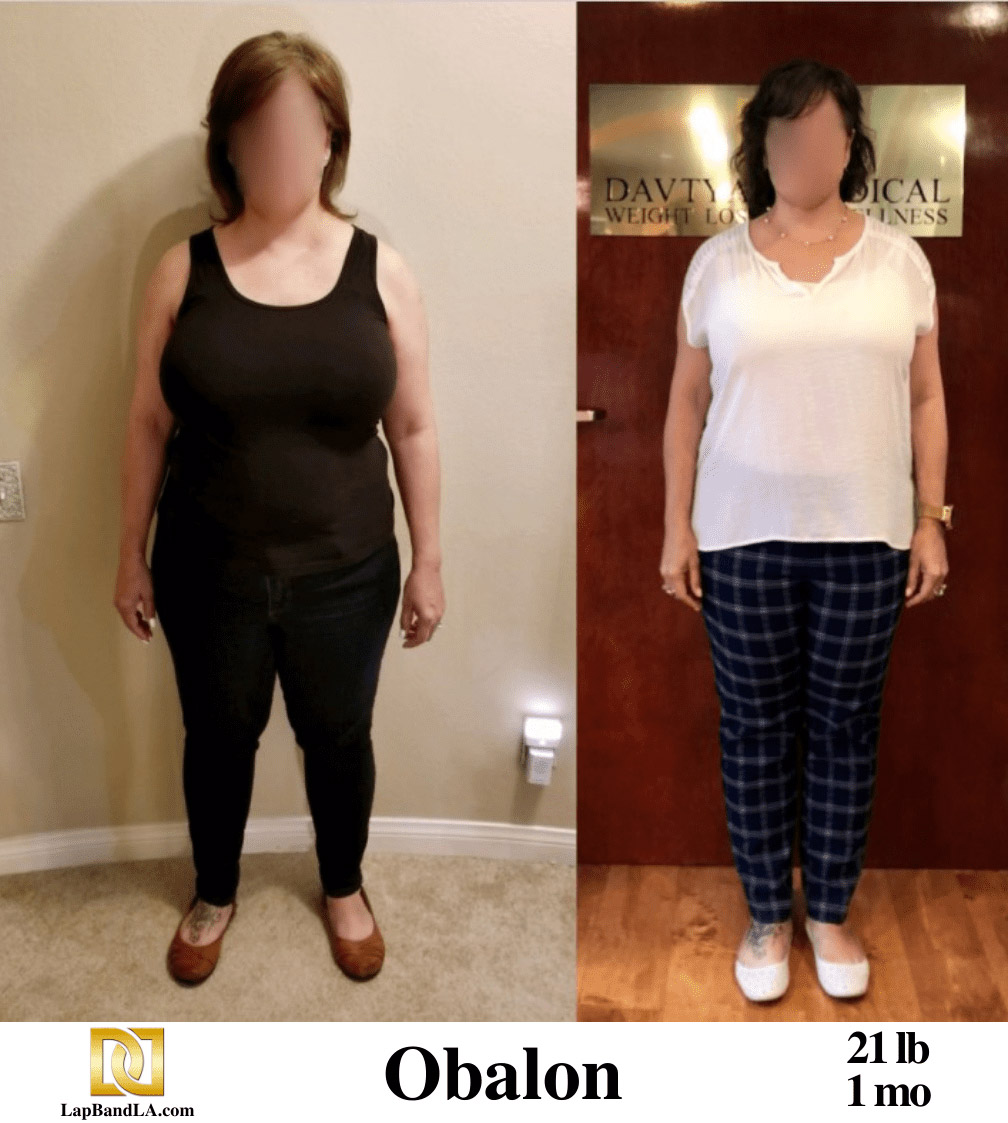 Dr Davtyan's Female Patient Before and After Bariatric Weight Loss Surgery