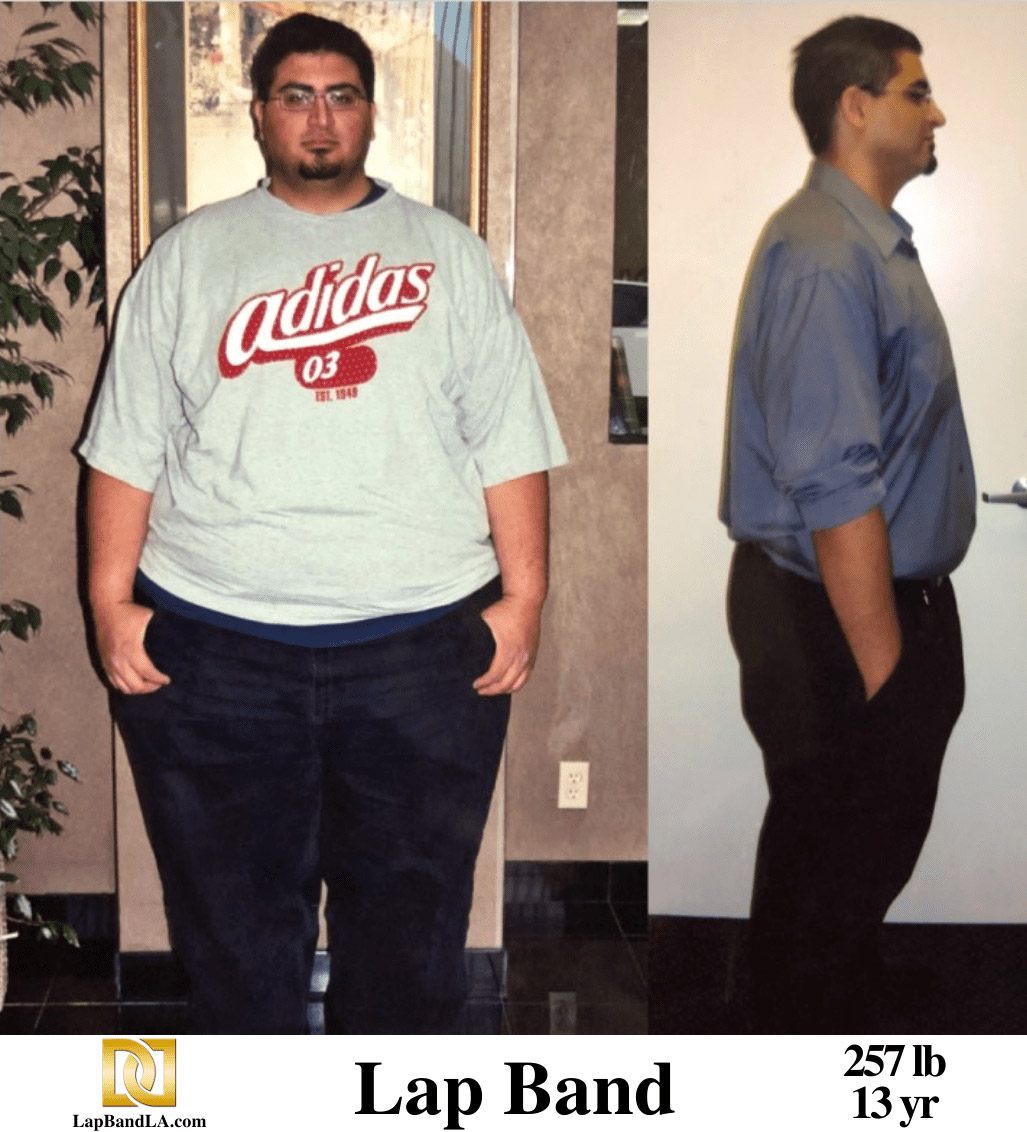 Dr Davtyan's male patient before and after lap band weight loss surgery