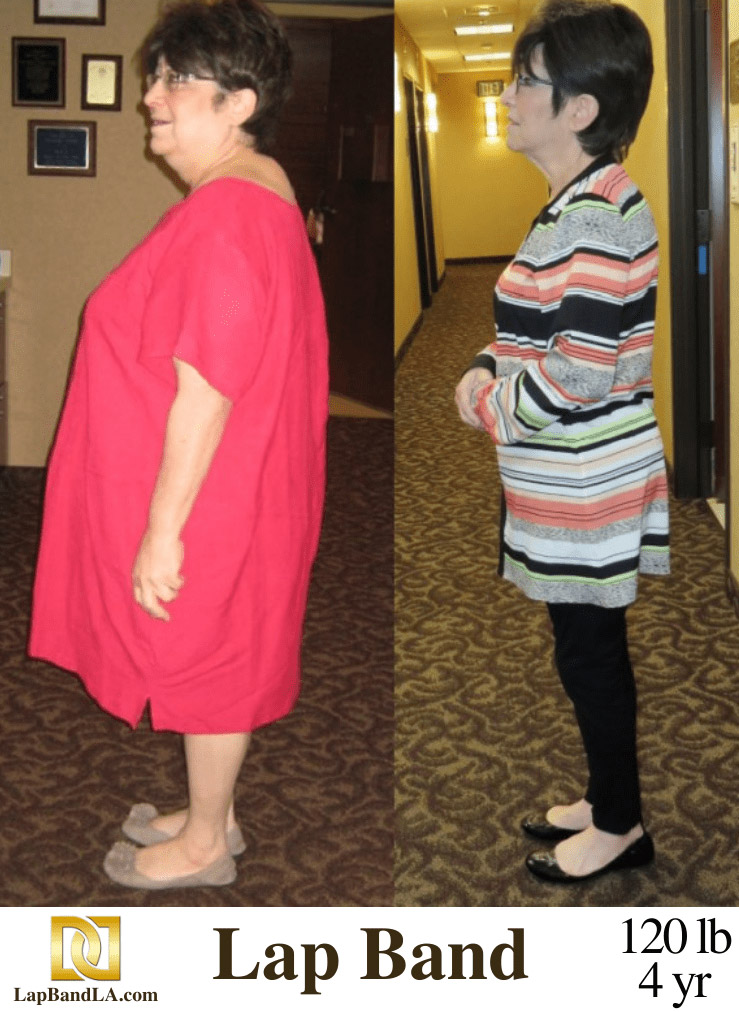 Dr Davtyan's Female Patient After Bariatric Weight Loss Surgery
