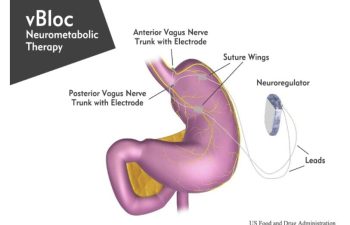 vBloc Neurometabolic therapy