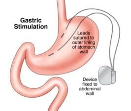 Gastric stimulation Vbloc Surgery Device