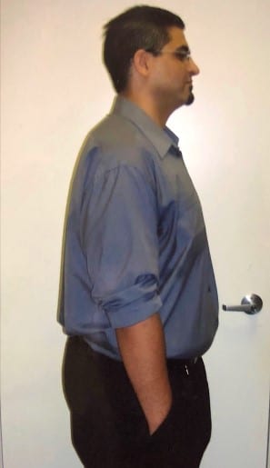 Nick M. Before and after Bariatric Surgery in The Weight Loss Surgery Center Of LA