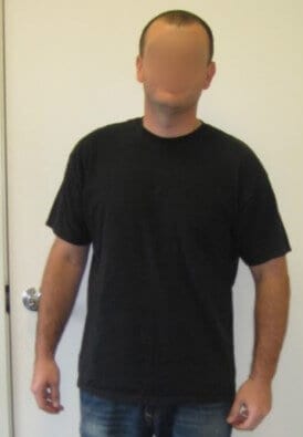 Michael G. Before and after Bariatric Surgery in The Weight Loss Surgery Center Of LA