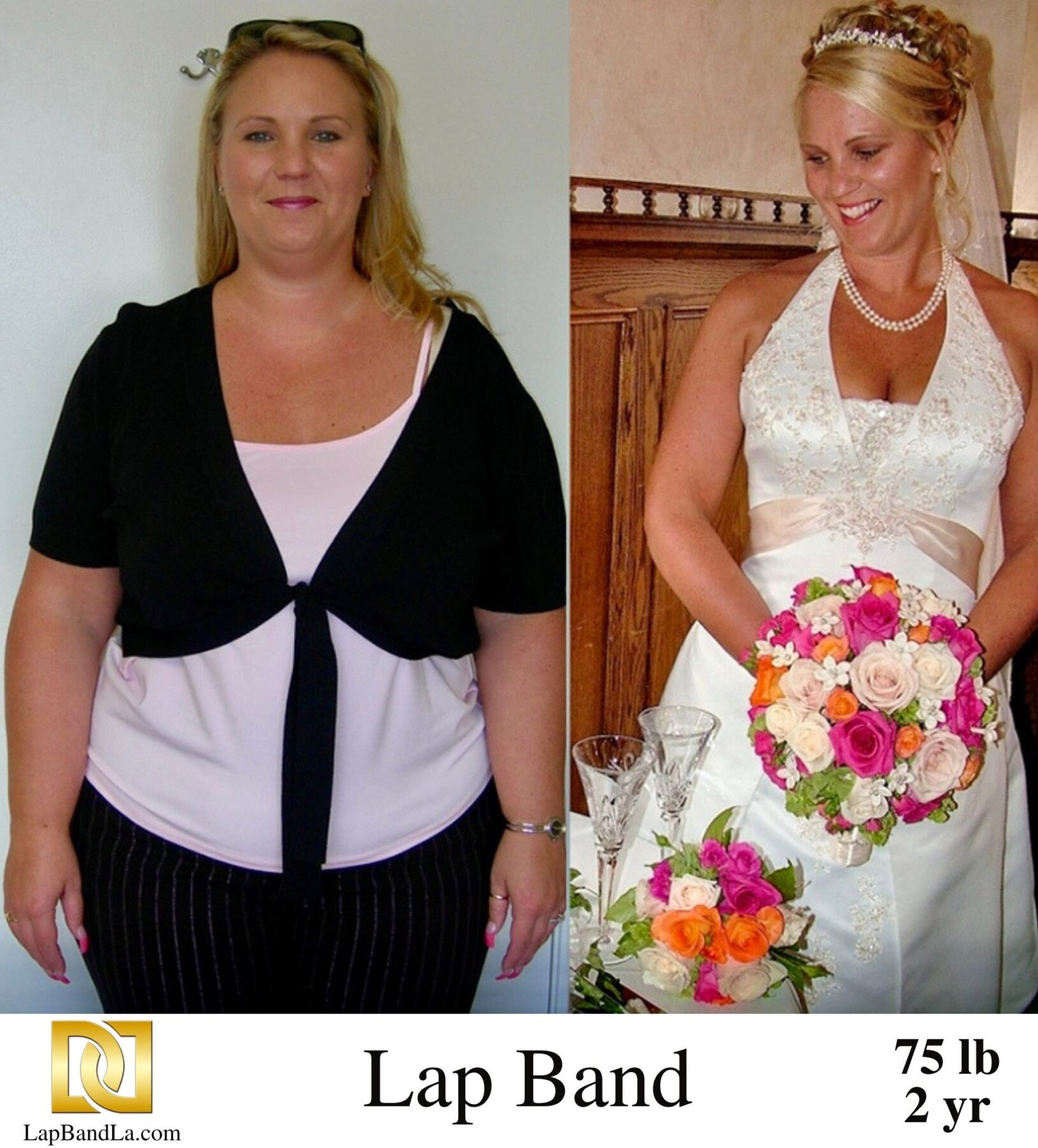 Stacy 2 years after lap band weight loss surgery.
