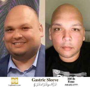 Dr Davtyan's male patient before and 8 months after lap band weight loss surgery