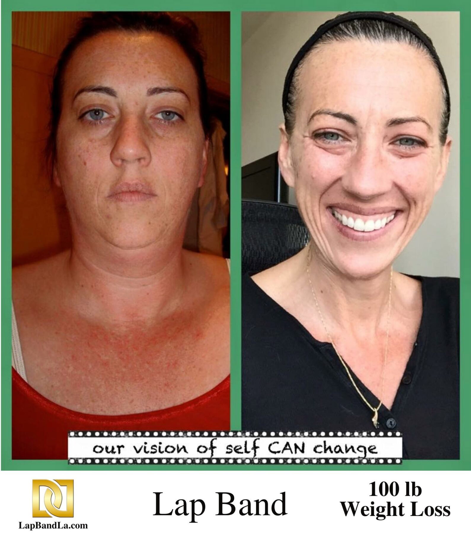 Dr Davtyan's lap band weight loss surgery female patient before and after