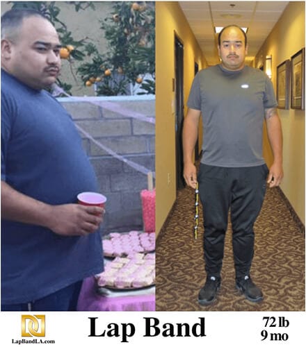 Dr Davtyan's lap band weight loss surgery male patient before and after