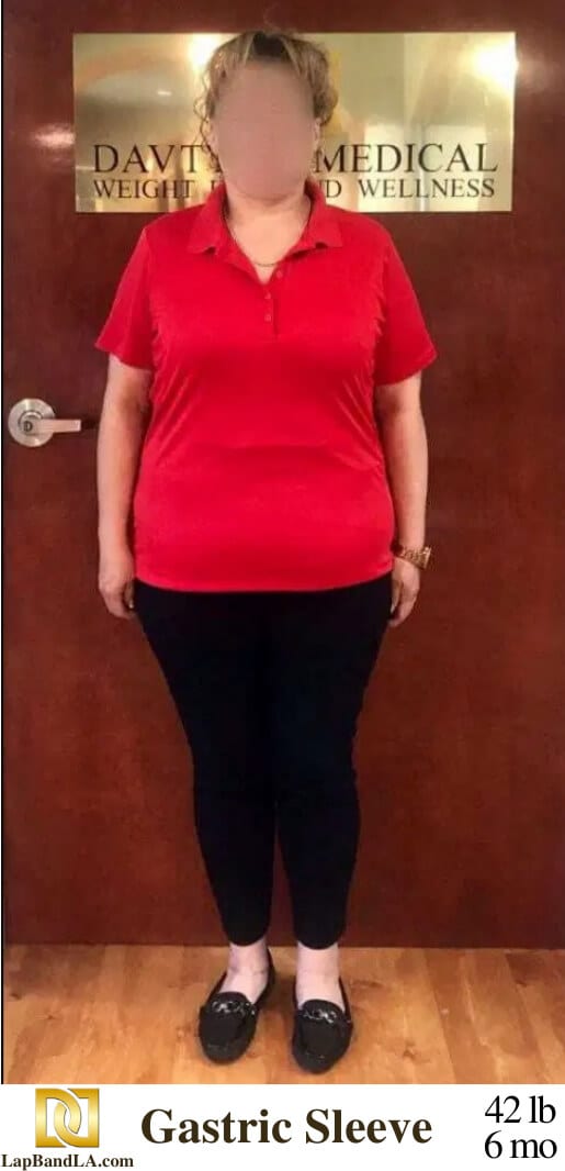 Dr Davtyan's Female Patient After Bariatric Weight Loss Surgery
