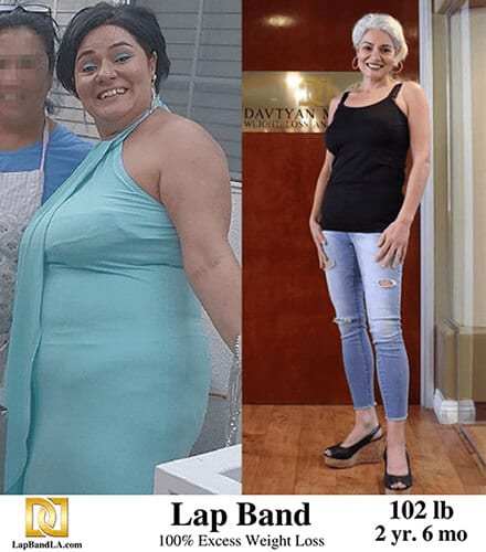 Dr Davtyan's female patient before and 2 years and 6 months after lap band weight loss surgery