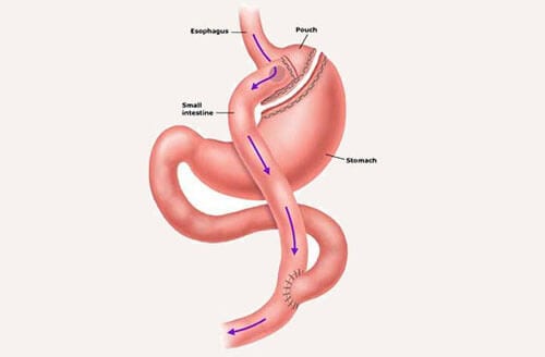 Gastric Bypass - The Weight Loss Surgery Center Of Los Angeles