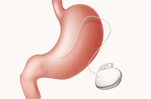 Gastric Pacemaker