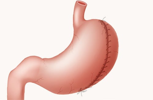Gastric Plication - The Weight Loss Surgery Center Of Los Angeles