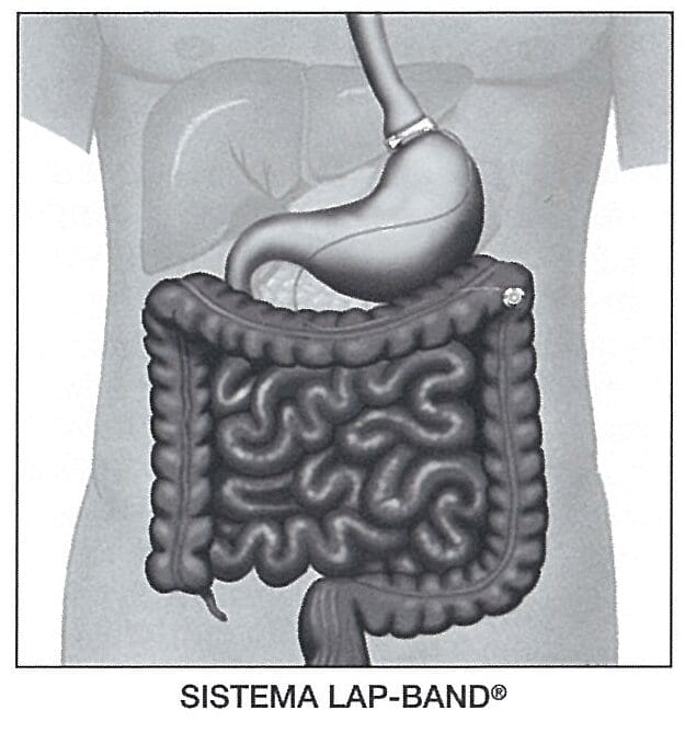 Sistema Lap-Band