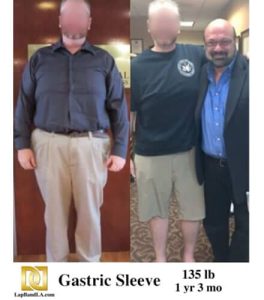 Dr Davtyan's lap band weight loss surgery male patient before and after