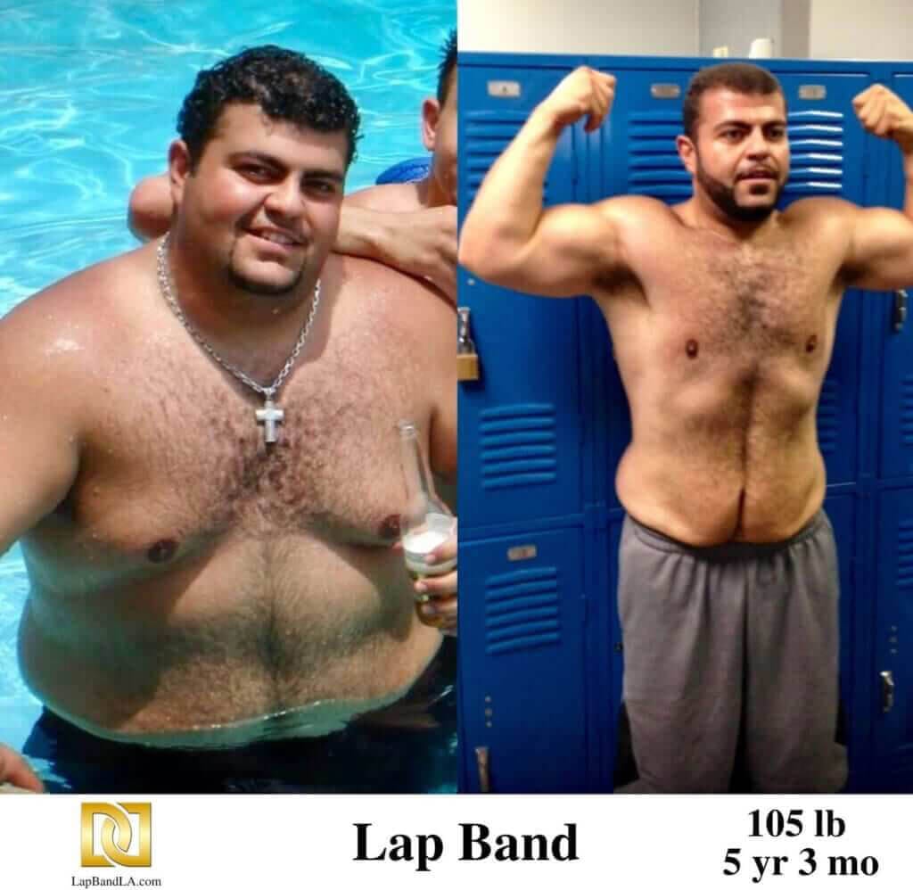 Dr Davtyan's male patient before and 5 years and 3 months after lap band weight loss surgery