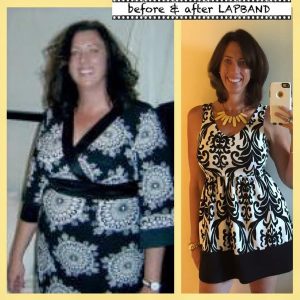 Lap Band Surgery Before And After Story In Los Angeles