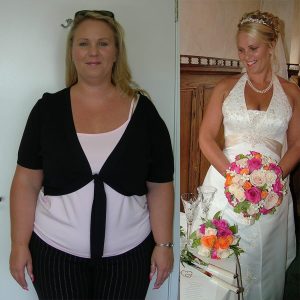 Lap Band Surgery Before and After Success Stories