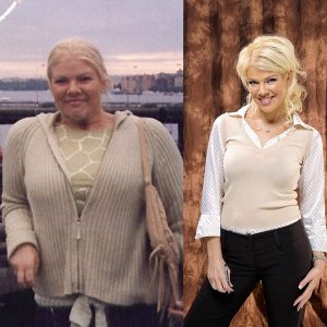 An Amazing Lap Band Surgery Before And After Story In The City Of Los Angeles
