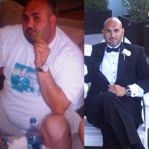 Lap Band Surgery Before and After Success Stories