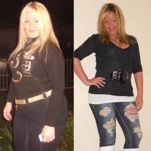 Sucesful Lap Band Surgery Results Before and After Testimonials