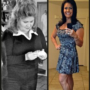 Before And After Lap Band Surgery Results In Los Angeles