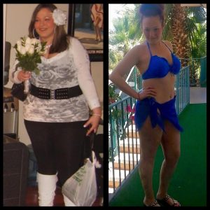 Incredible Lap Band Surgery Results Before and After At The Weight Loss Surgery Center Of Los Angeles