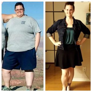 Lap Band Surgery Before And After Results at The Weight Loss Surgery Center Of Los Angeles