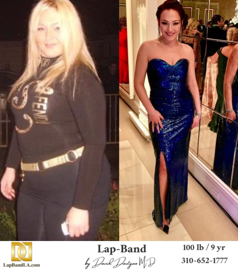 Bariatric Surgery - Before & After Weight Loss Photo - Lap-Band® Patient
