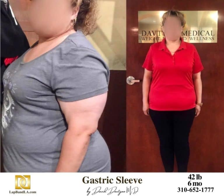 Weight Loss Surgery Before and After Gallery | The Weight Loss Surgery ...