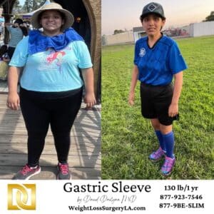 Dr Davtyan's Weight Loss Gastric Sleeve Patient Before and After comparison