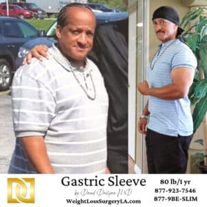 Dr Davtyan's Weight Loss Gastric Sleeve Male Patient Before and After comparison
