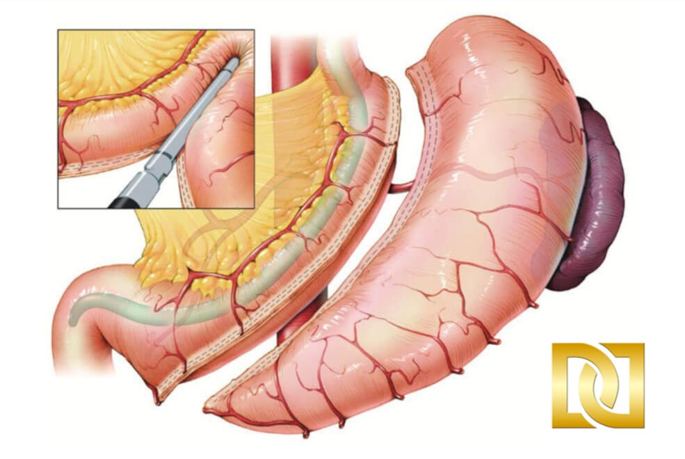 Gastric Sleeve Anatomy At The Weight Loss Surgery Center Of Los Angeles