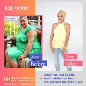 Zoey Lap-Band Weight loss surgery before and after comparison