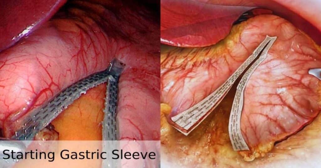 gastric sleeve surgery laparoscopic process
