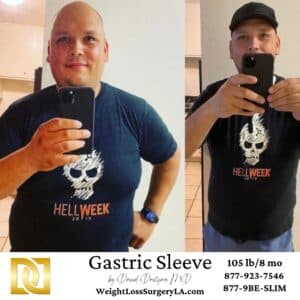 Gastric Sleeve Before and After of Jesus