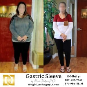Sleeve Gastrectomy before and after comparison