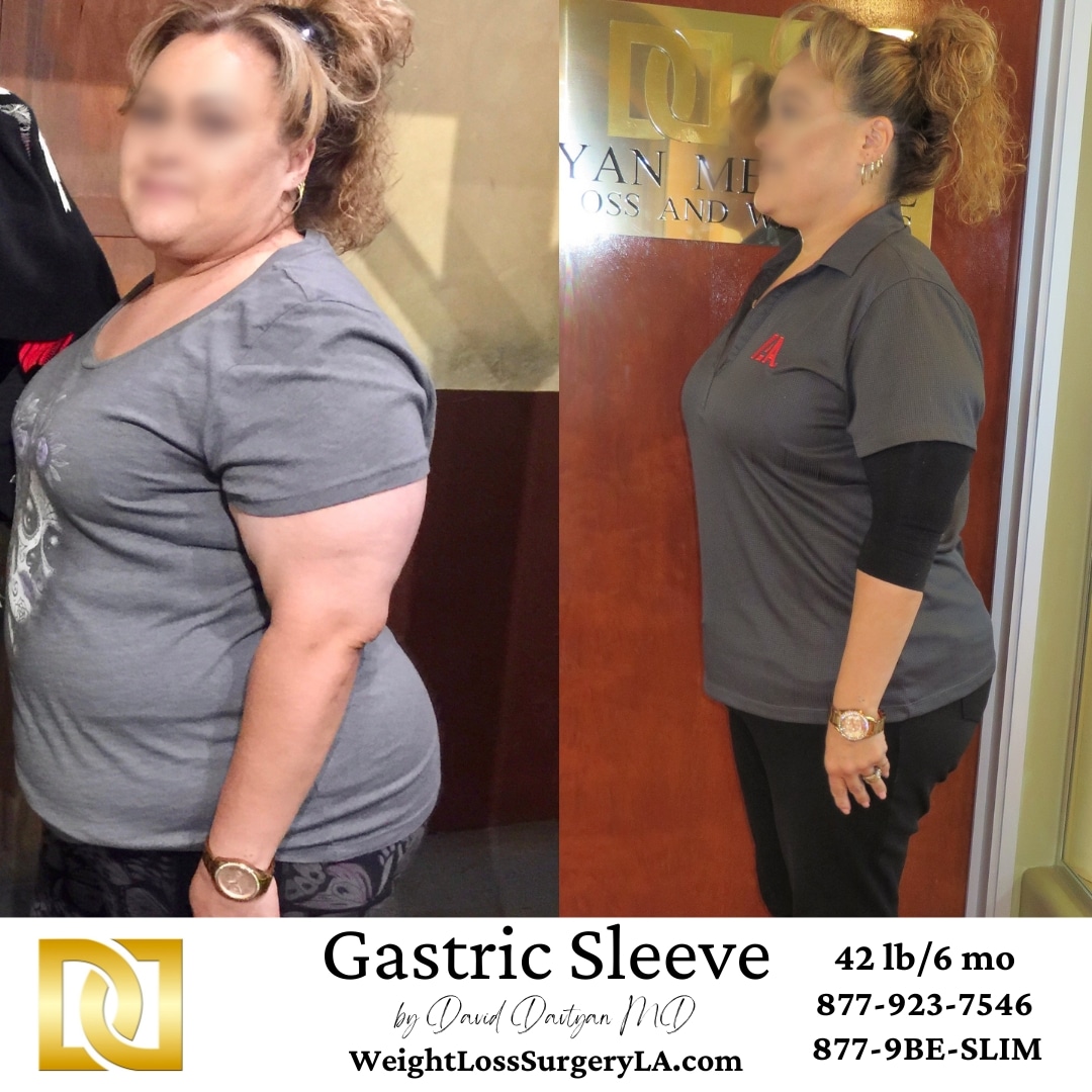 Gastric Sleeve Surgery before and after results in Los Angeles