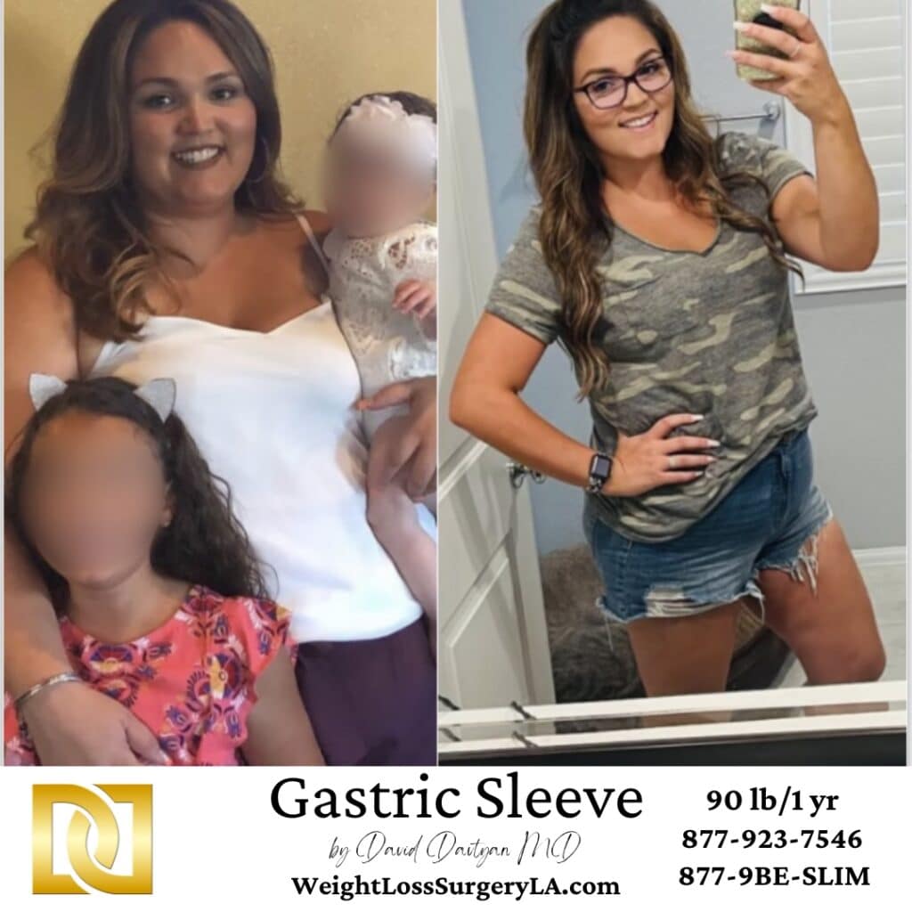 Gastric Sleeve Before and After Photos