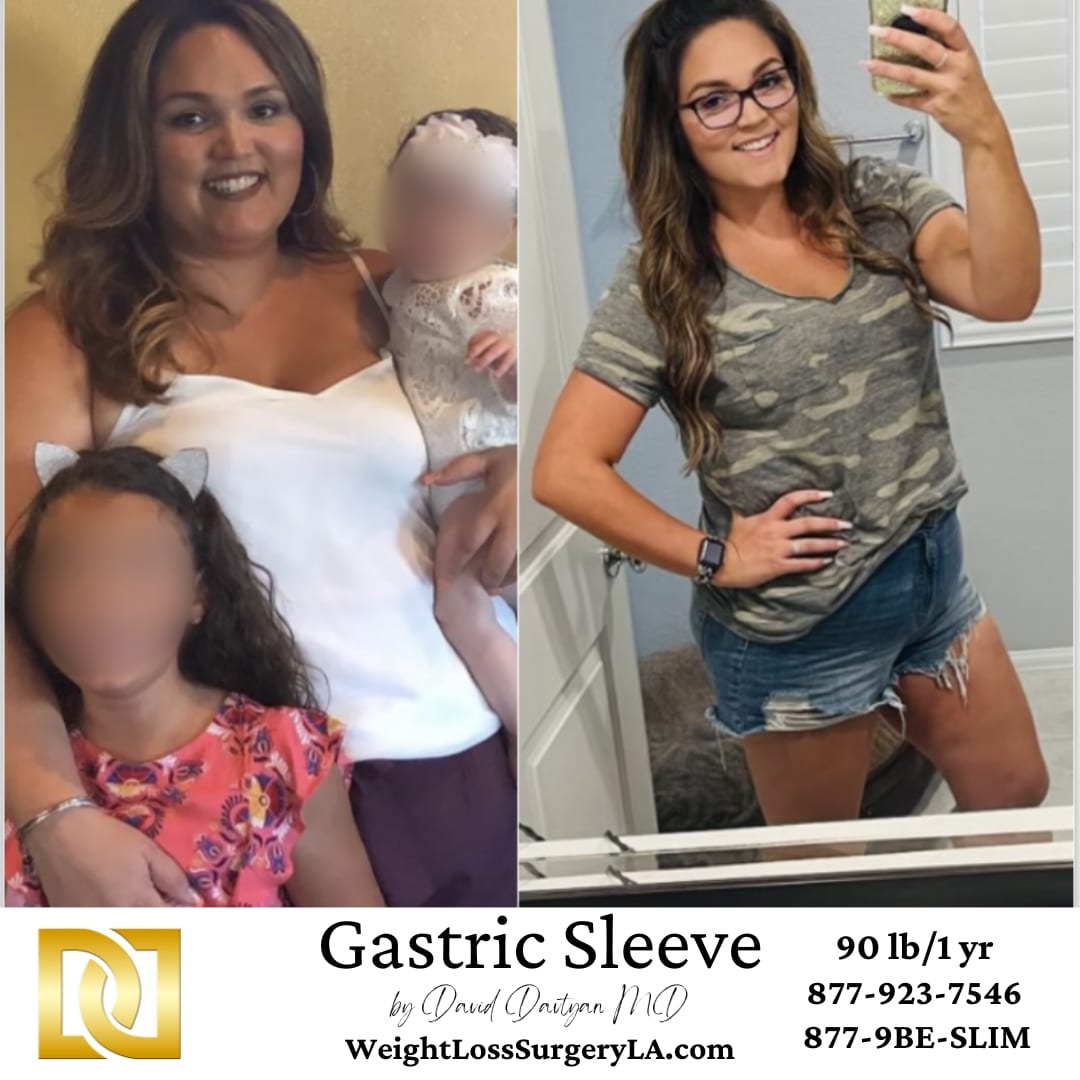 Gastric Sleeve Surgery Before and After comparison of Weight Loss Surgery Center of Los Angeles
