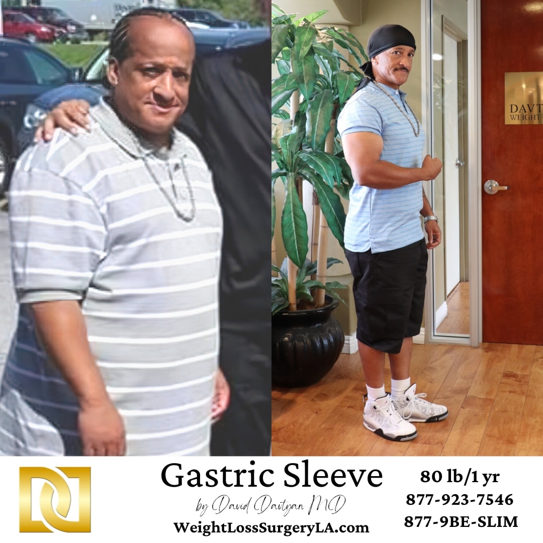 Gastric Sleeve Before and After of Antonio