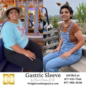 Gastric Sleeve before after Jessica