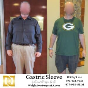 Gastric Sleeve Male Patient before after