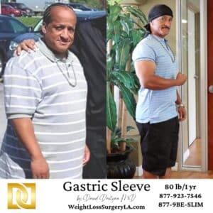 Antonio Gastric Sleeve Before and After Photo