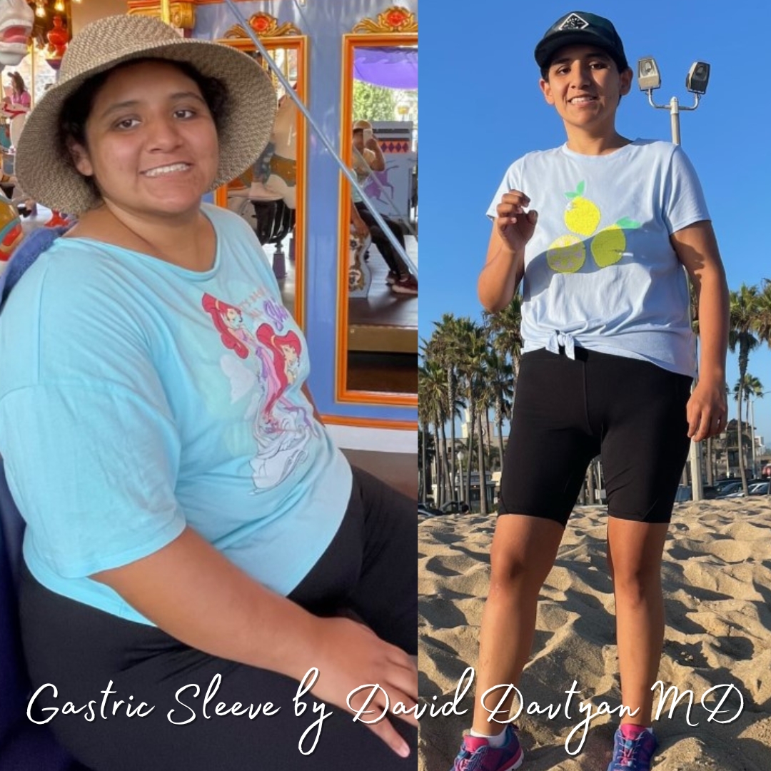 Gastric Sleeve Before and After Photos - The Weight Loss Surgery Center Of Los Angeles