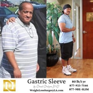 Gastric Sleeve Before and After of Antonio 