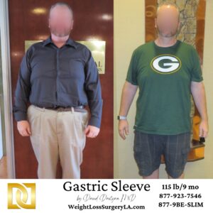 Gastric Sleeve Male Patient before after
