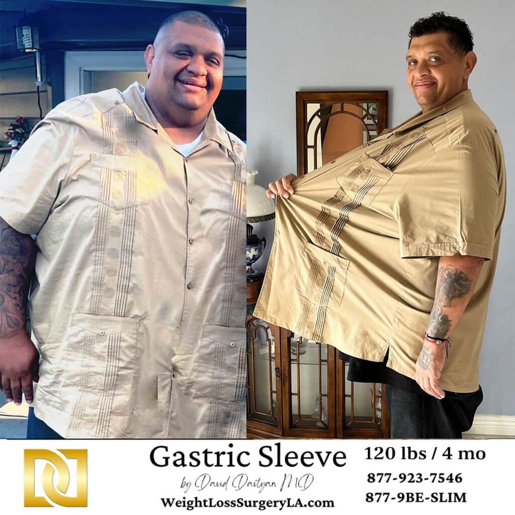 Dr. Davtyan gastric sleeve patient lost 190 lbs in just 4 mo