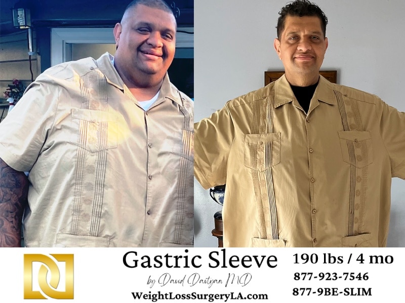 Before and after photo of a patient who lost nearly 190 pounds in just 4 months after gastric sleeve surgery at Davtyan Medical Weight Loss and Wellness.